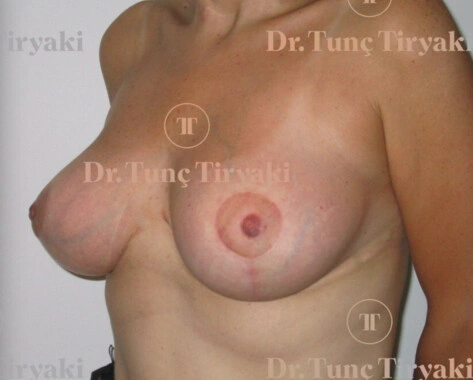 After Breast Reduction | Gallery Image 2