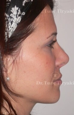 After Fat Transfer to the Face | Gallery Image 3