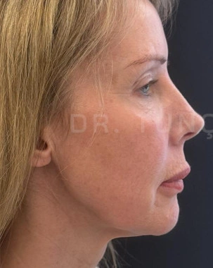 Before Facial Stem Cell Treatment | Gallery Image 28