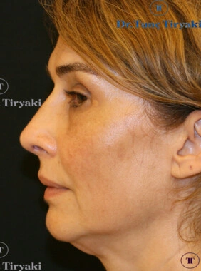 After Rhinoplasty | Gallery Image 2