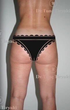 After Liposuction | Gallery Image 3