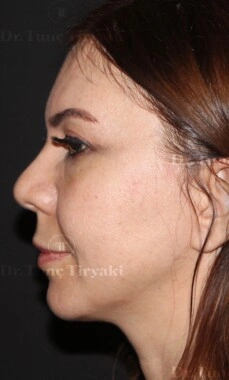 Before Micro-Facelift | Gallery Image 3