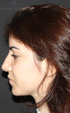 Before Facial Stem Cell Treatment | Gallery Image 8