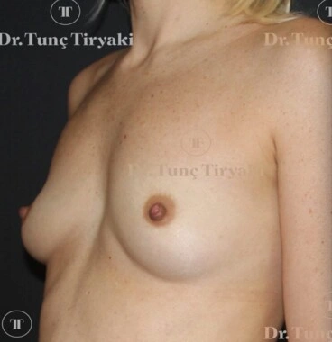 Before Breast Augmentation | Gallery Image 4
