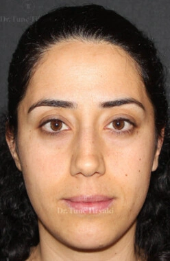 Before Facial Stem Cell Treatment | Gallery Image 19