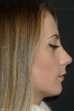 After Choosing the Right Plastic Surgeon | Gallery Image 2