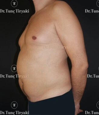 Before Liposuction | Gallery Image 1
