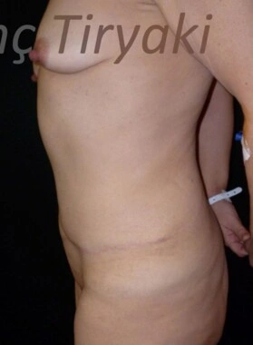 After Tummy Tuck | Gallery Image 2