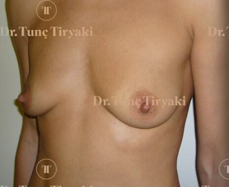 Before Breast Augmentation | Gallery Image 2