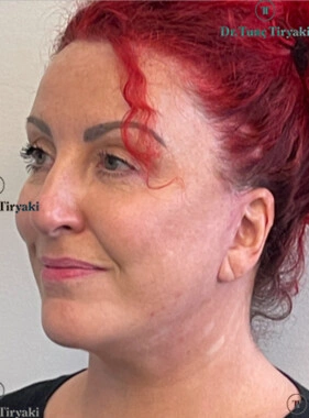 After Blepharoplasty (Eyelid Surgery) | Gallery Image 11