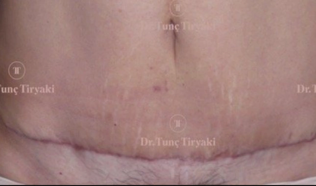 Before Endoscopic Tummy Tuck | Gallery Image 2