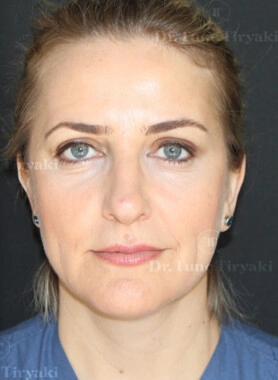 After Facial Stem Cell Treatment | Gallery Image 16