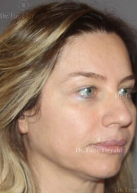 Before Facial Stem Cell Treatment | Gallery Image 22