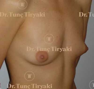 Before Breast Augmentation | Gallery Image 1