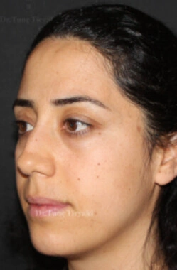 Before Facial Stem Cell Treatment | Gallery Image 21