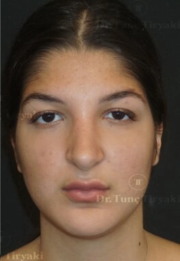 After Rhinoplasty | Gallery Image 3