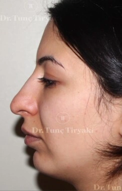 Before Nose Tip Plasty | Gallery Image 2