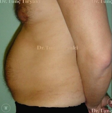 Before Tummy Tuck | Gallery Image 1