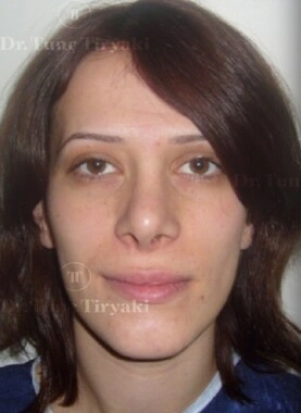 Before Fat Transfer to the Face | Gallery Image 1