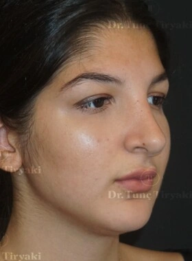After Rhinoplasty | Gallery Image 5