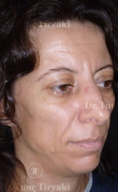 Before Fat Transfer to the Face | Gallery Image 7