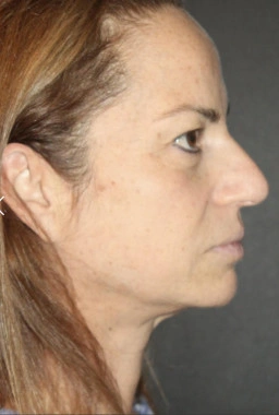 Before Nano Facelift | Gallery Image 3