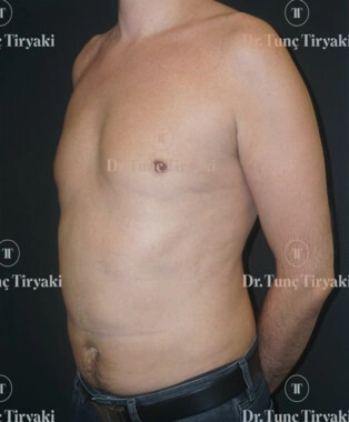 After Liposuction | Gallery Image 1