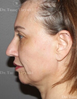 Before Nose Tip Plasty | Gallery Image 4