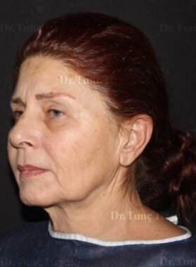 Before Neck Lift | Gallery Image 1