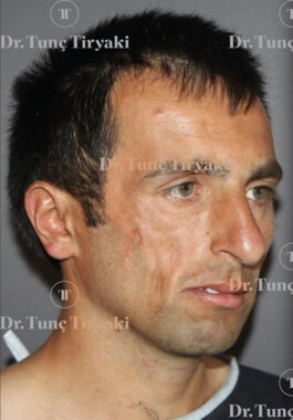 Before Facial Stem Cell Treatment | Gallery Image 2