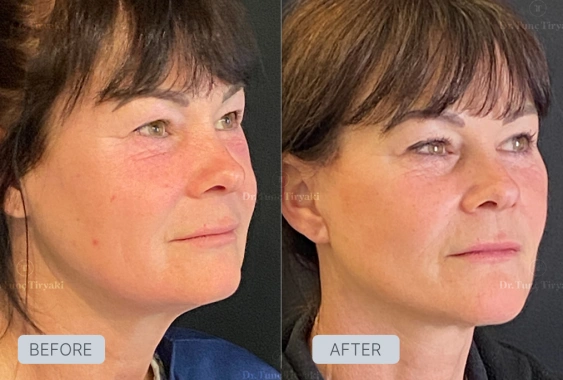 Before Facelift Recovery Guide - Stages & What to Expect | Gallery Image 3
