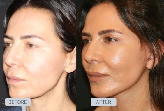 Before Facelift Recovery Guide - Stages & What to Expect | Gallery Image 2