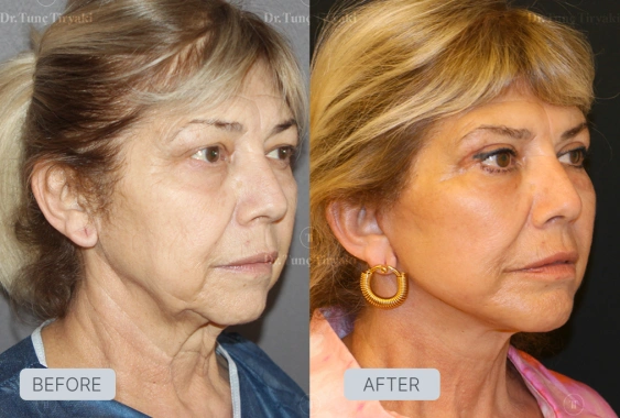 After Facelift Recovery Guide - Stages & What to Expect | Gallery Image 2