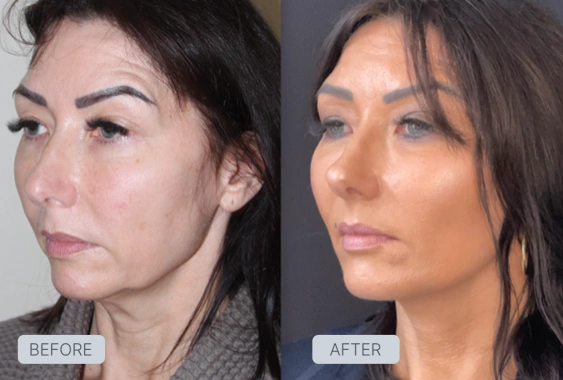 After Facelift Recovery Guide - Stages & What to Expect | Gallery Image 1