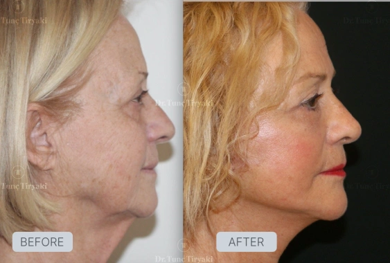 Before Facelift Recovery Guide - Stages & What to Expect | Gallery Image 1