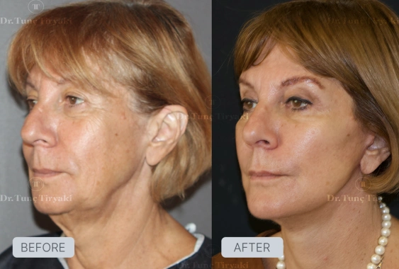 After Facelift Recovery Guide - Stages & What to Expect | Gallery Image 3