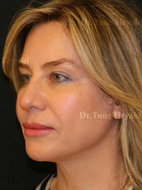 After Facial Stem Cell Treatment | Gallery Image 24