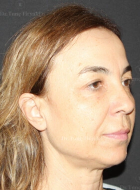 Before Facial Stem Cell Treatment | Gallery Image 13