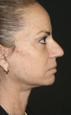After Nano Facelift | Gallery Image 3