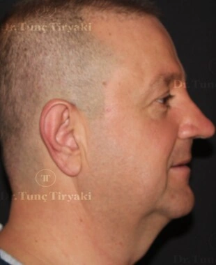 Before Micro-Facelift | Gallery Image 9