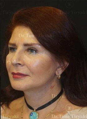 After Choosing the Right Plastic Surgeon | Gallery Image 3