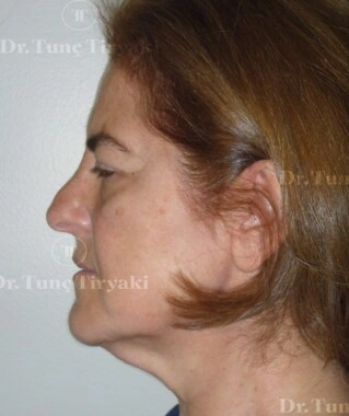 Before Nose Tip Plasty | Gallery Image 5