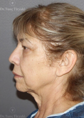 Before Facial Stem Cell Treatment | Gallery Image 27