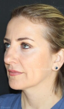 After Facial Stem Cell Treatment | Gallery Image 18