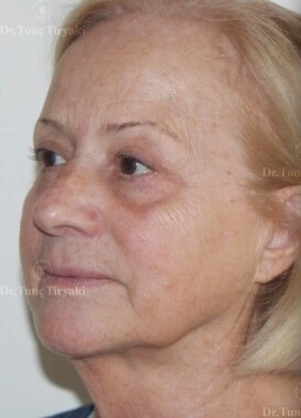 Before Neck Lift | Gallery Image 3