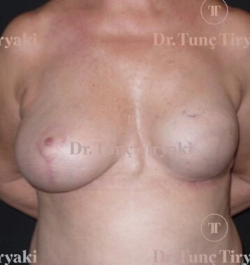 After Breast Reconstruction | Gallery Image 2