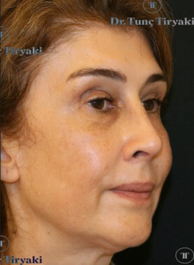 After Rhinoplasty | Gallery Image 1