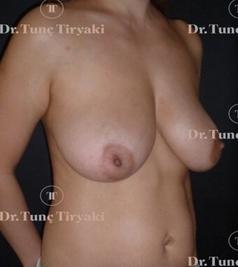 Before Breast Reduction | Gallery Image 1
