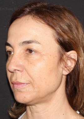 Before Facial Stem Cell Treatment | Gallery Image 15
