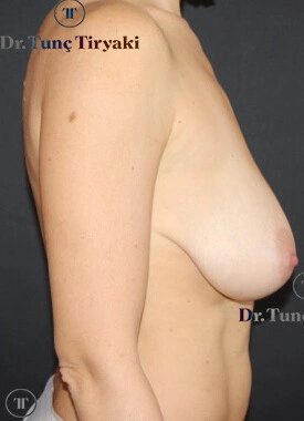 Before Breast Lift | Gallery Image 3